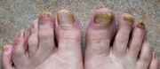 Antifungal Foot Care Serum N- Scientific- https://tinyurl.com/fhtdc8w